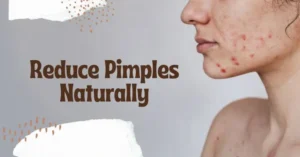 Reduce Pimples Naturally